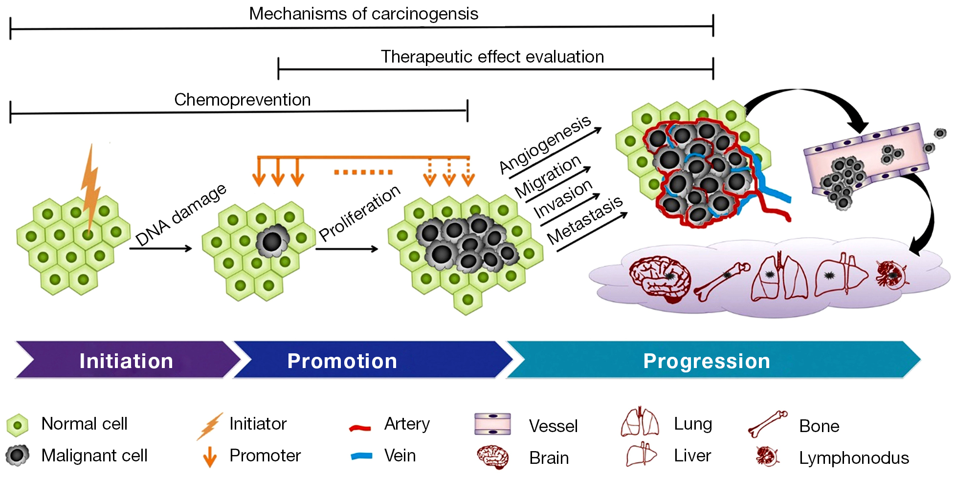 Lymphonodus. Канцерогенез легких. Мутационная теория канцерогенеза этапы. Stages of carcinogenesis. Онкогенез картинки.